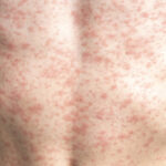 A person's body is covered in a rash, measles.