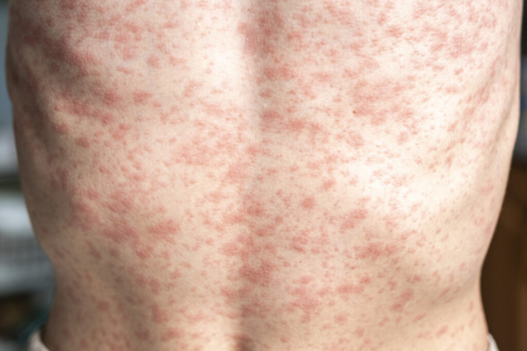 A person&#039;s body is covered in a rash, measles.