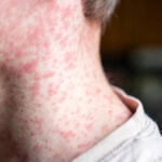 sarampion-es-muy-contagioso-091734