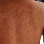 getty-images-sarampion-185855